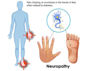 Pins and needles, tingling, or numbness in the hands or feet may develop when persistently raised blood sugar begins to affect the nerves. This early nerve irritation, known as peripheral neuropathy, can worsen over time if blood sugar levels remain high.